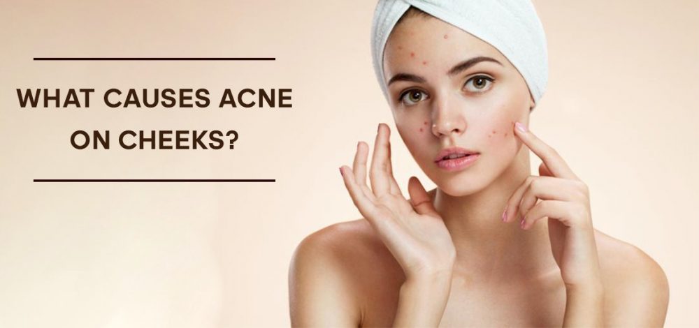 what-causes-acne-on-cheeks-symptoms-and-easy-prevention-tips