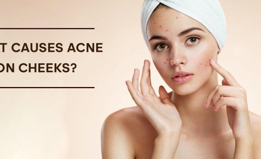 How Much Do You Know about What Causes Acne On Cheeks?